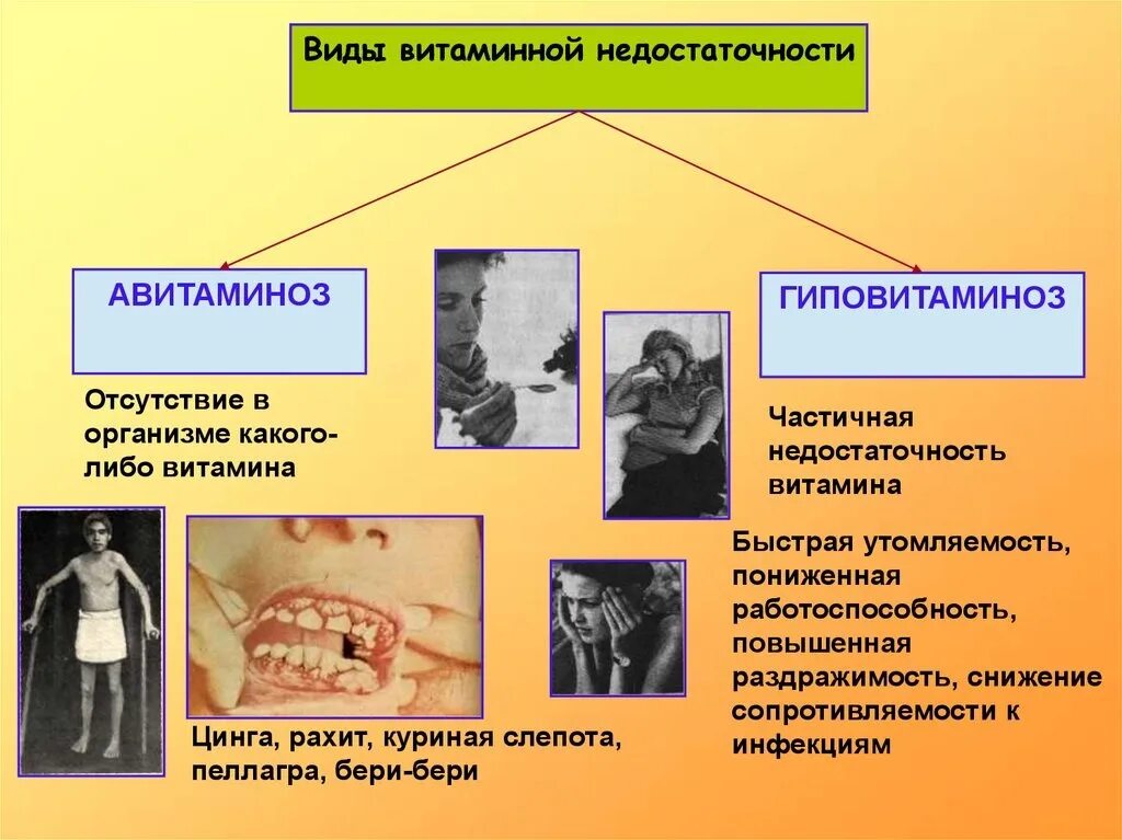 Дефицит витамина болезнь рахит цинга. Авитаминоз и гиповитаминоз. Патологии при авитаминозе. Недостаточность витаминов авитаминозы и гиповитаминозы.