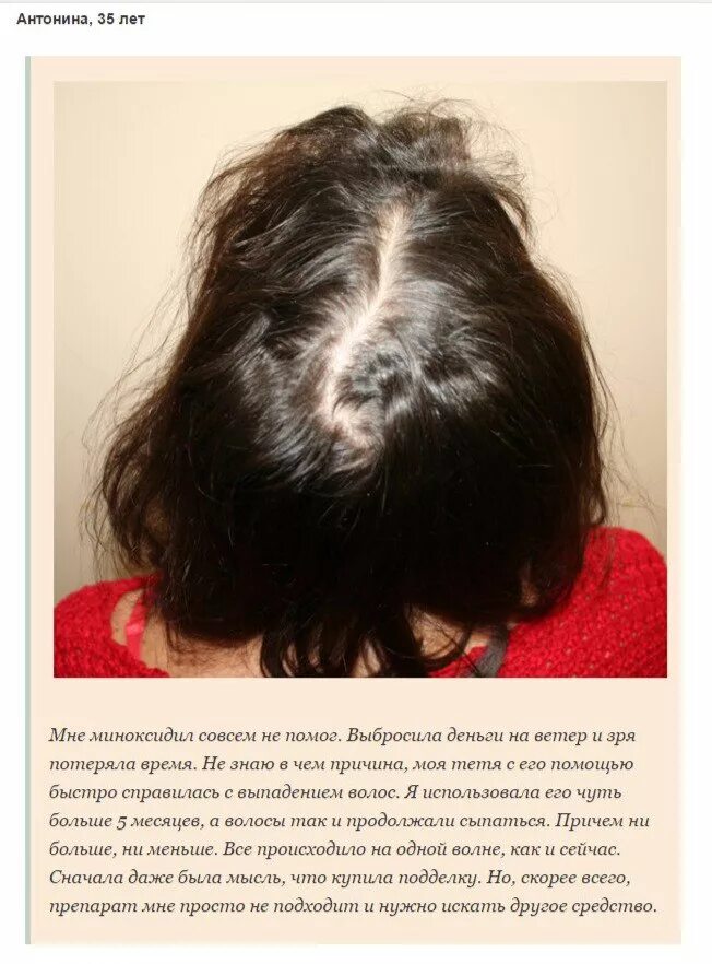 Как долго выпадают волосы после