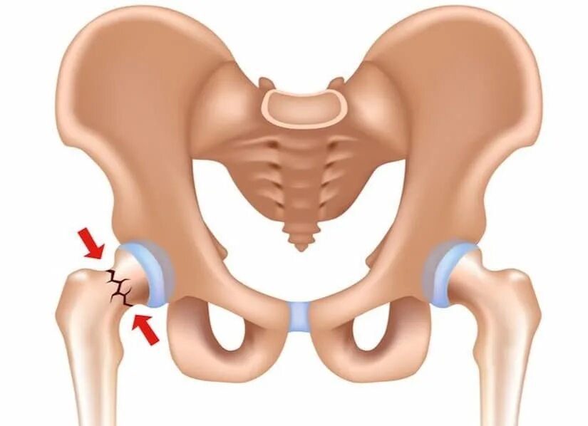 Перелом костей тазобедренного сустава. Перелом тазобедренного сустава и кости. Тазобедренный сустав шейка бедра. Перелом шейки бедра перелом костей таза. Симптомы шейка бедра у женщины