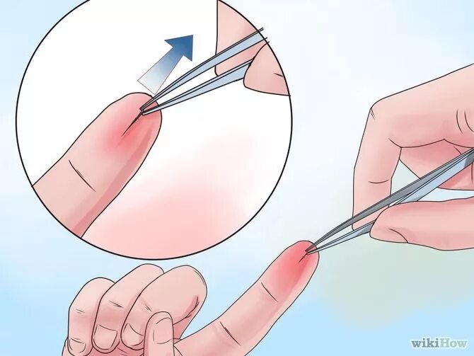 Как вытащить занозу из пальца. Может ли заноза выйти сама. Может ли заноза выйти сама. Как вытащить занозу из пальца без иголки. Жаноза.