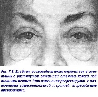 Микседема при гипотиреозе