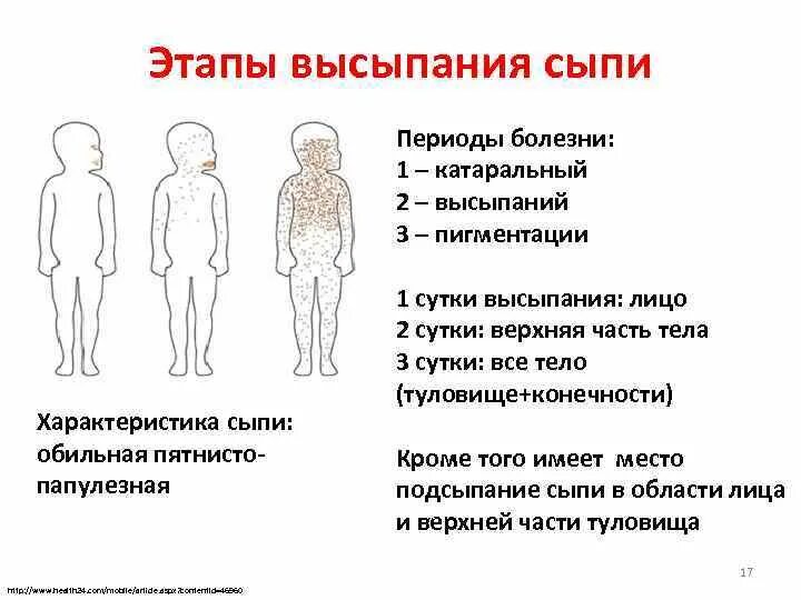 Этапность появления сыпи при кори. Корь этапы высыпания сыпи. Локализация сыпи при разных заболеваниях. Этапность высыпаний сыпи при кори.