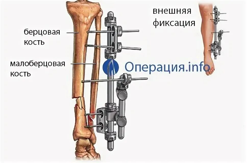 Перелом бедренной кости аппарат Илизарова. Аппарат наружной фиксации остеосинтез. Чрескостный остеосинтез. Аппарат внешней фиксации при переломе большеберцовой кости. Операция малоберцовой кости