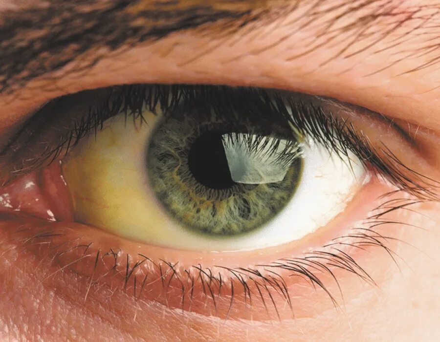 Мутно желтые глаза. Пожелтение склер гепатит. Иктеричность конъюнктивы.