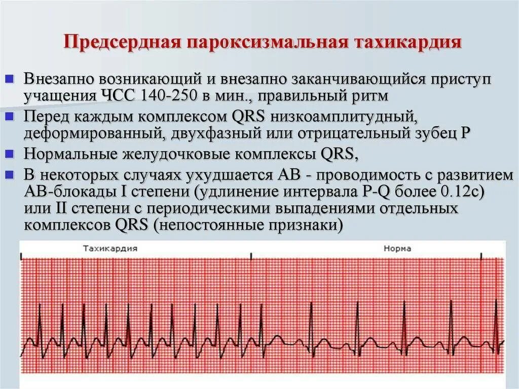 Аритмичные тоны сердца. Отрицательный зубец р после QRS комплекса. Предсердная пароксизмальная тахикардия на ЭКГ. Предсердная пароксизмальная тахикардия на ЭКГ признаки. ЭКГ критерии пароксизмальной суправентрикулярной тахикардии.