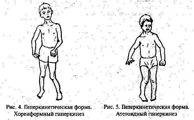 Гиперкинетическая форма при ДЦП. Дети с гиперкинетической формой ДЦП. Типы гиперкинезов при ДЦП. Гемипаретическая форма дцп