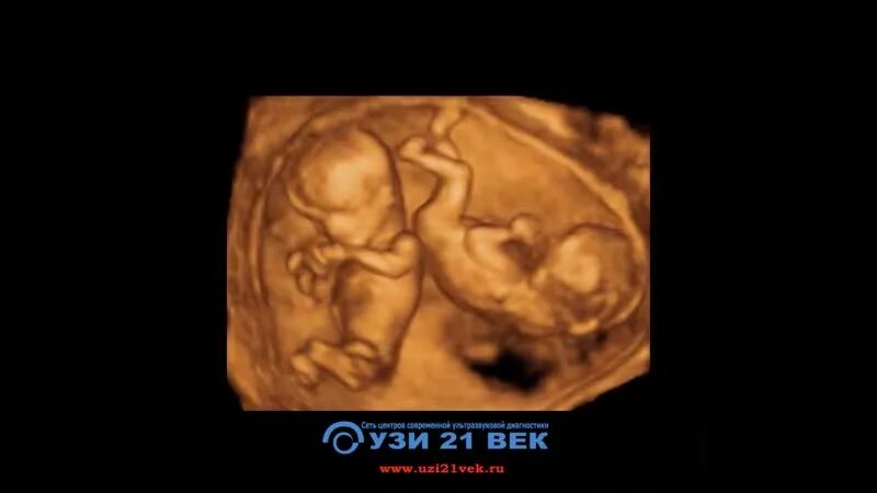 Гармония екатеринбург 3д узи. 4д узи екатеринбург. 4 д узи беременности пермь. 21 неделя беременности 3д узи. Гармония екатеринбург 3д узи.