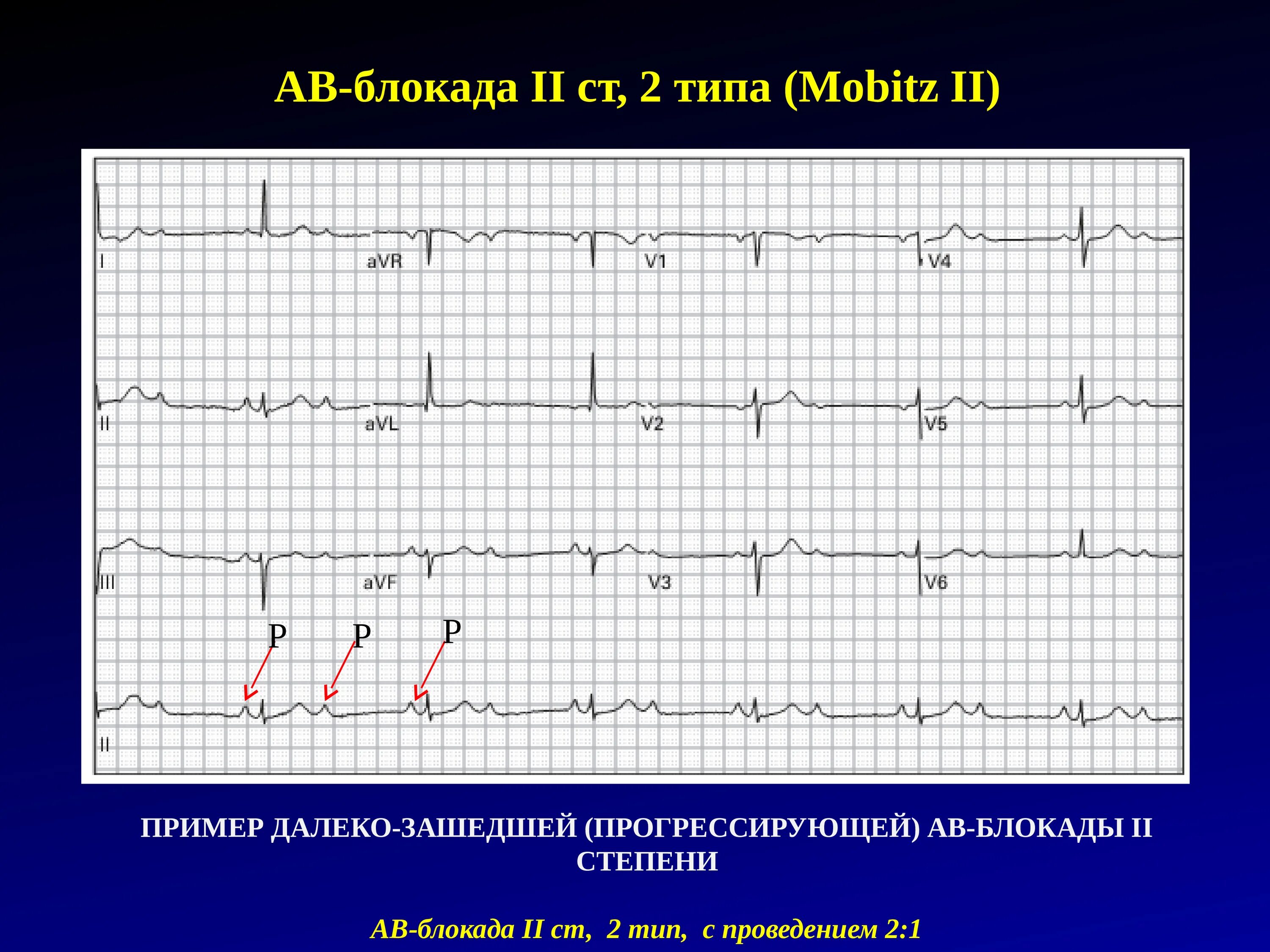 Атриовентрикулярная блокада 2. АВ блокада 2 ст 1 Тип. АВ блокада 2 ст 2 типа. Типы АВ блокады 2 степени. АВ-блокада 2 степени Мобитц 1 с проведением 2:1.