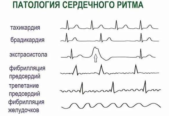 Пульс при всд