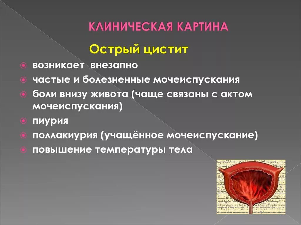 Резкое частое мочеиспускание. Цистит клиническая картина. Острый цистит презентация. Частое болезненное мочеиспускание это. Острый цистит симптомы у женщин.