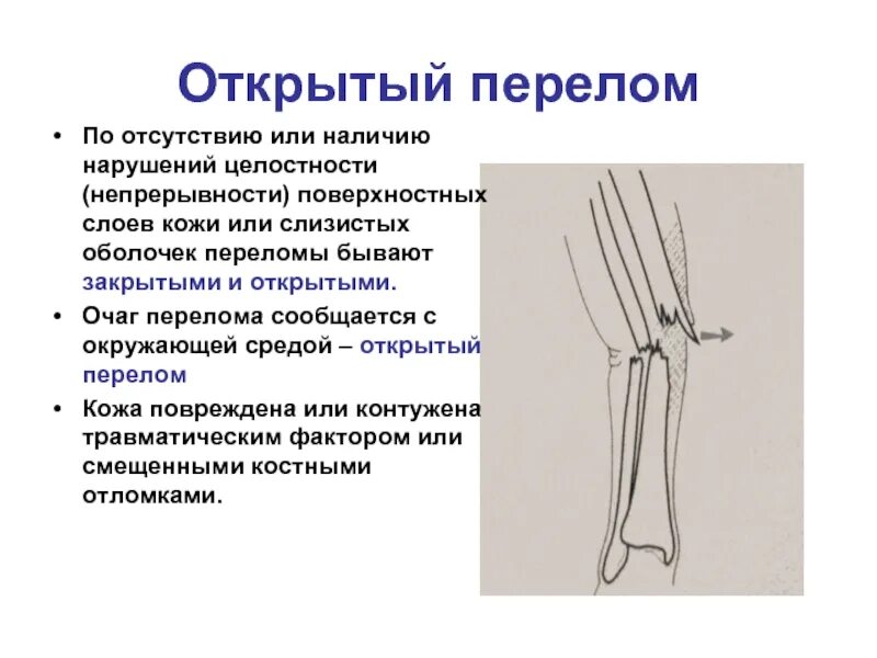 Открытая трещина. Открытый и закрытый перелом.