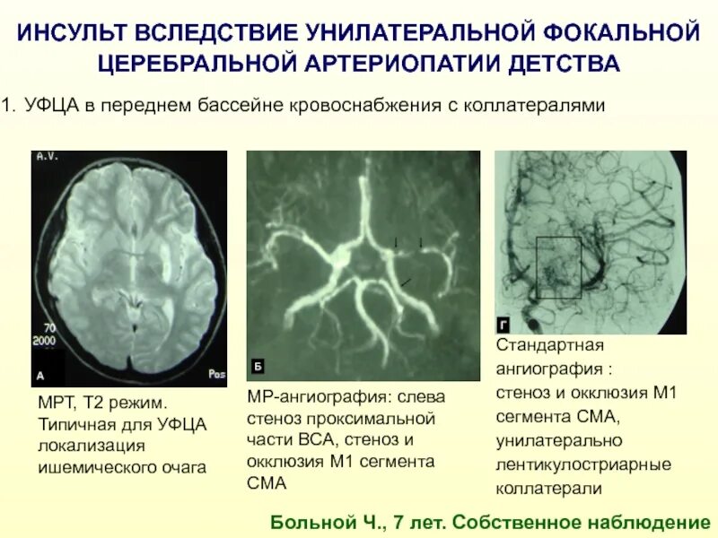 Инсульт в бассейне мозговой артерии. Ишемический инсульт ангиография. Кт ангиография инсульт. Ишемический инсульт кт ангиография. Ангиография при инсульте головного мозга.