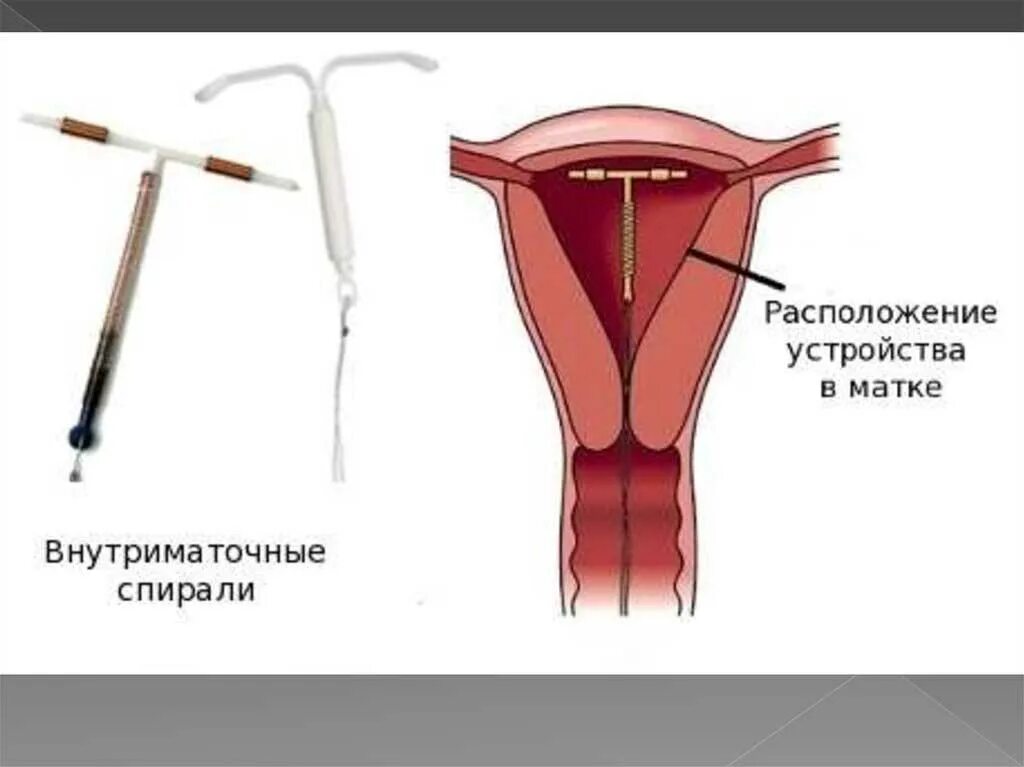 Вмс шейки матки. Спираль противозачаточная мирена. внутриматочные противозачаточные спирали. спираль внутриматочная мирена в матке. вмс внутриматочная спираль.
