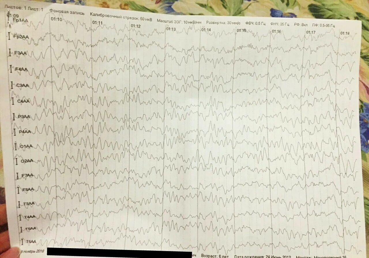 Ээг отзывы детям. Заключение ЭЭГ. Плохой результат по ЭЭГ. Фильтр высоких частот на ЭЭГ. ЭЭГ норма и патология.