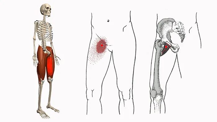 Боли в паху спереди. Гребенчатая мышца триггерные точки. Триггерные точки портняжная мышца. Малая ягодичная триггерные точки.