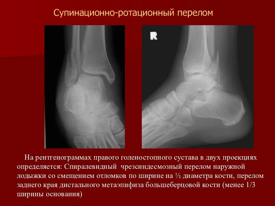 Супинационно-аддукционный перелом лодыжки. Абдукционный перелом лодыжки. Перелом двухлодыжечный перелом. Двухлодыжечный перелом левой голени.