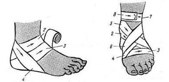 Какая повязка при повреждении голеностопного сустава. Повязка на голеностопный сустав десмургия. Забинтовать голеностоп эластичным бинтом. Бинтование эластичным бинтом голеностопного сустава. Перевязка эластичным бинтом пятку.