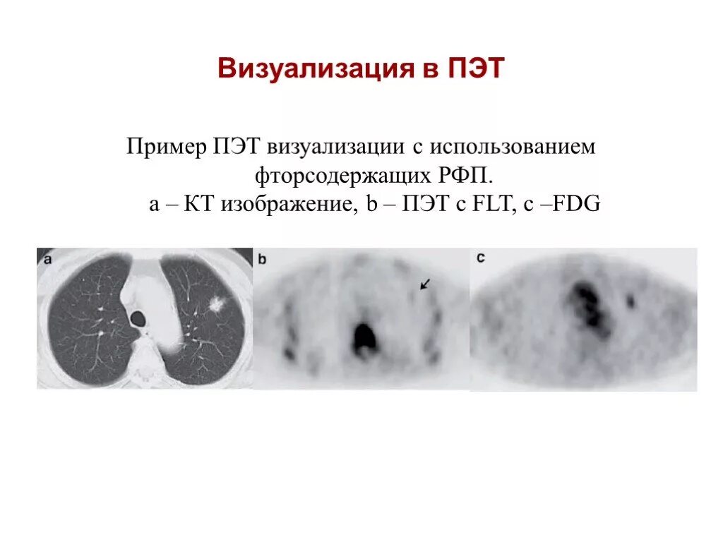 Рфп при пэт кт. РФП используемые в ПЭТ кт. Совмещенные изображения кт ПЭТ И ПЭТ-кт. РФП. Радиофармпрепарат ФДГ.