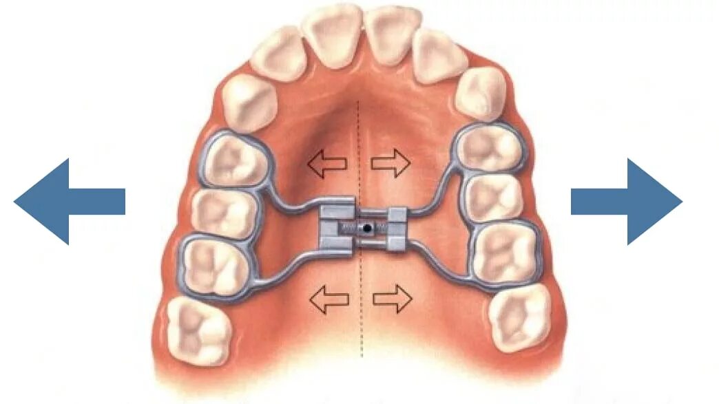 Аппаратмарк россортодонтия. Система на верхнюю челюсть. Система на верхнюю челюсть. Аппарат форсуа ортодонтия. Аппарат макнамара ортодонтия.