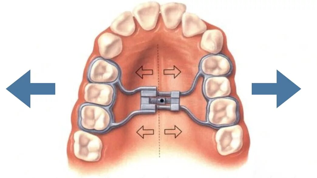 Расширение челюсти аппарат Дерихсвайлера. Аппарат Дерихсвайлера ортодонтия. Аппарат Дерихсвайлера (Марко Росса). Аппарат Норда ортодонтия. Аппарат хасса
