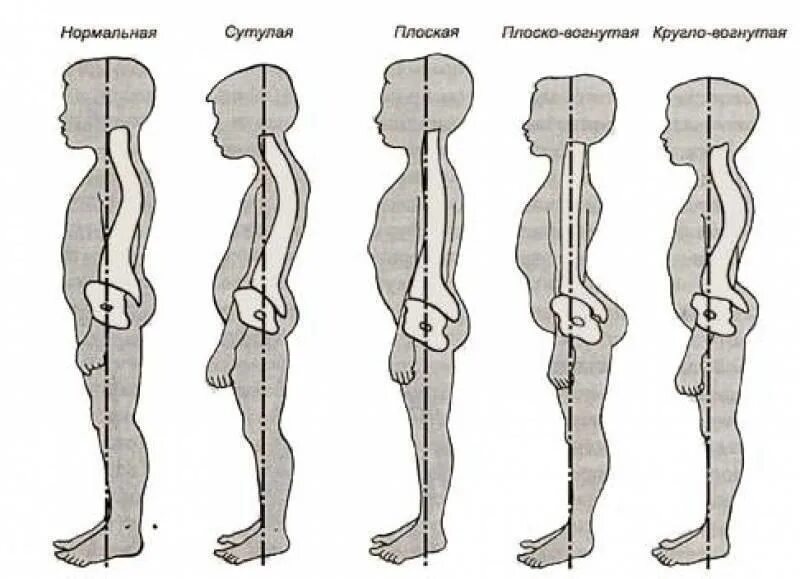 Правильная форма члена. Искривление позвоночника прогиб в пояснице. Типы осанки по штаффелю. Сколиоз Тип осанки. Нарушение осанки вогнутая спина.