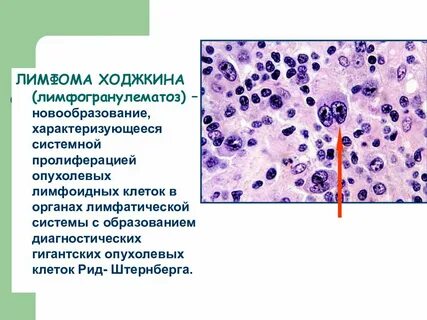 Пролиферация лимфоидных клеток