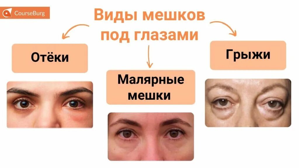 Мешки под глазами причина у мужчин лечение. Мешки под глазами виды и типы разновидности.