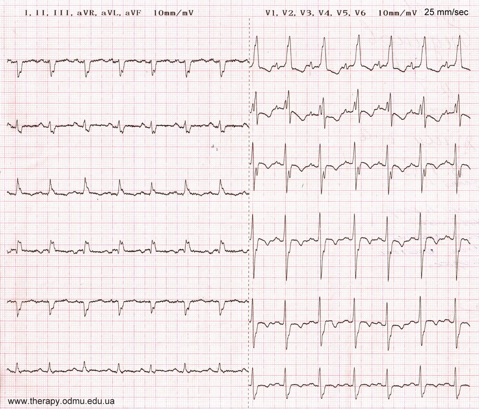 Блокада qrs. Блокада ПНПГ на ЭКГ. RSR ЭКГ В AVL. QRS типа RSR В v1. ЭОС при блокаде правой ножки пучка Гиса.