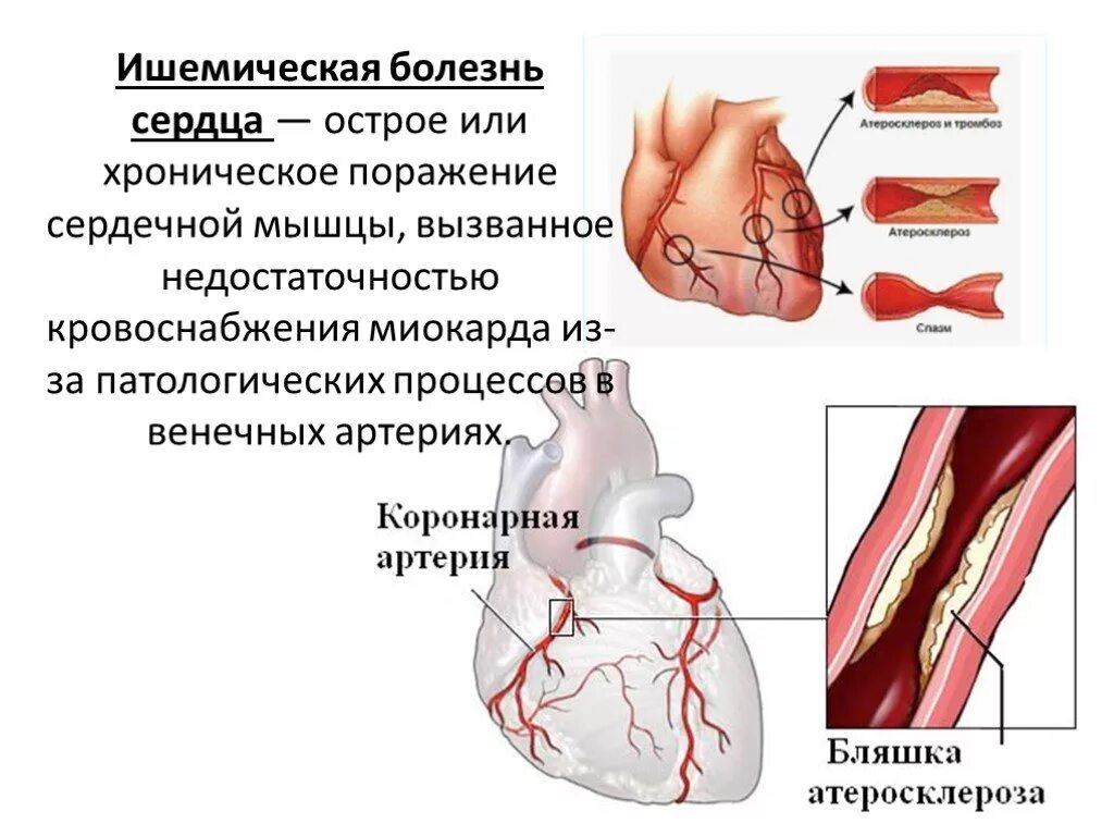 Ишемия мышц