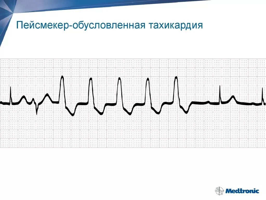Пейсмекер. Пейсмекеры сердца это. гиперсенсинг. водители ритма пейс мейкеры сердце. пейсмекер-индуцированная тахикардия.