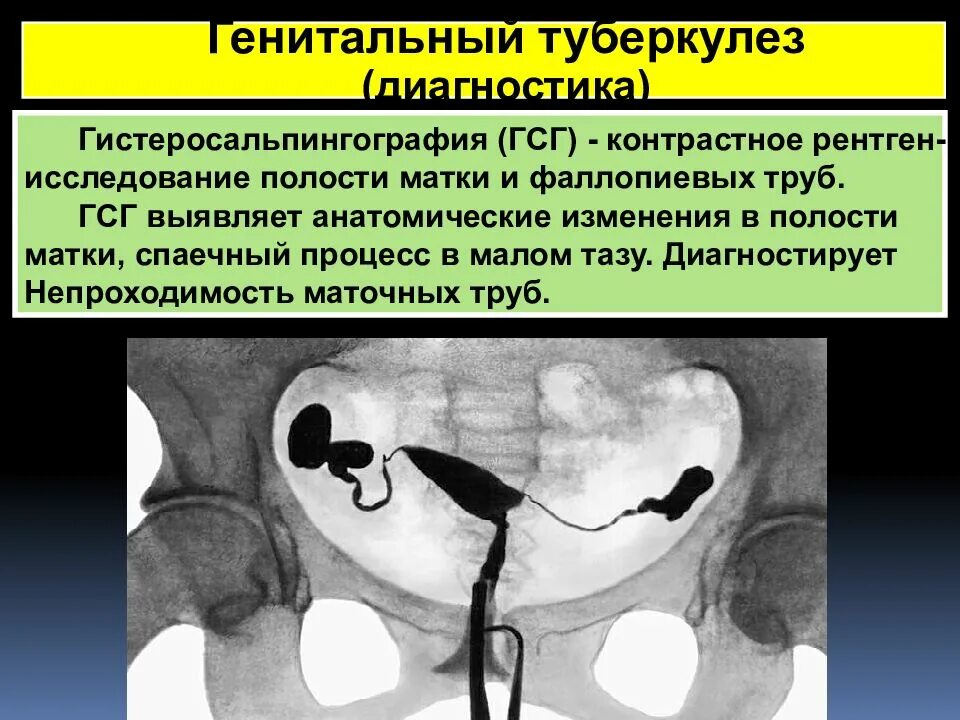 Забеременела при непроходимости труб. Туберкулез половых органов гистеросальпингография. Гидросальпингоскопия маточных. Гистеросальпингография рентген маточных труб. Гистеросальпингография проходимость маточных труб рентген.