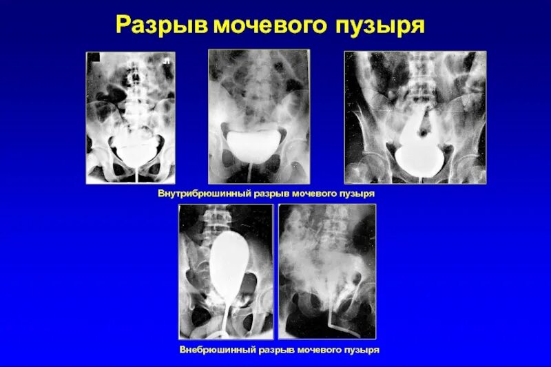 Разрыв пики. Внутрибрюшинное повреждение мочевого пузыря. Внебрюшинное повреждение мочевого пузыря. Внебрюшинный и внутрибрюшинный разрыв мочевого пузыря.