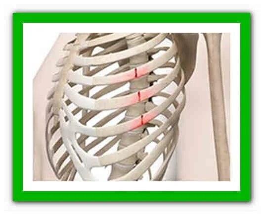 Множественные переломы ребер. Неосложненный перелом ребра.