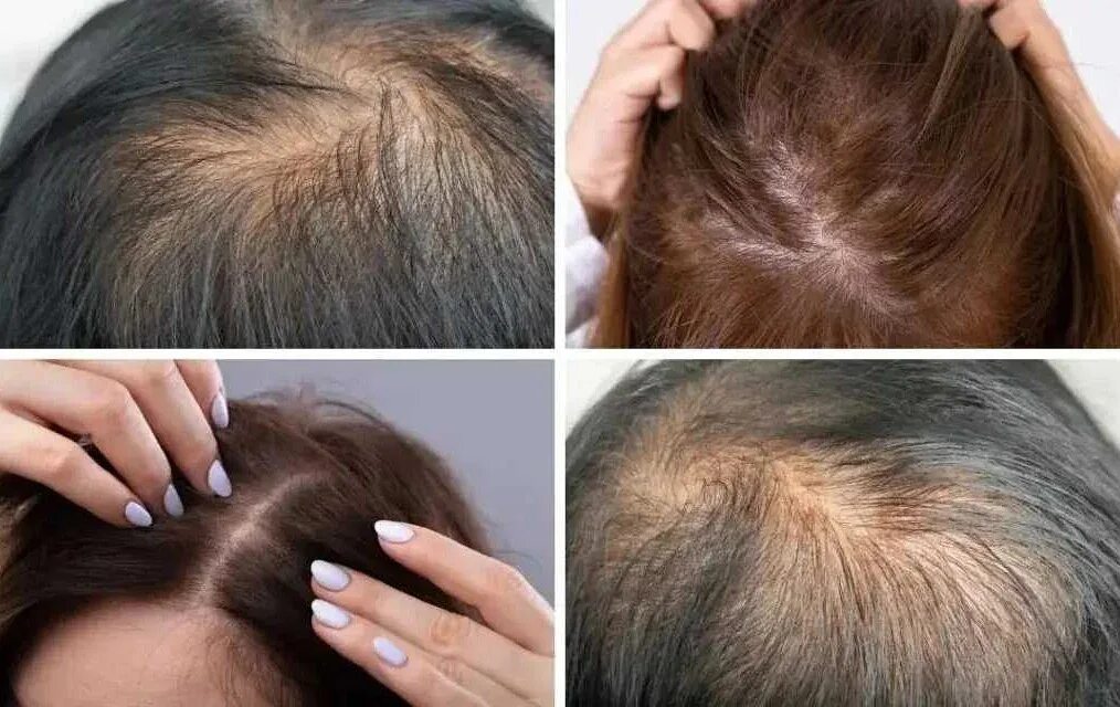 Причину выпадения волос после 40. Телогеновая алопеция волос. Андрогенетическая алопеция.