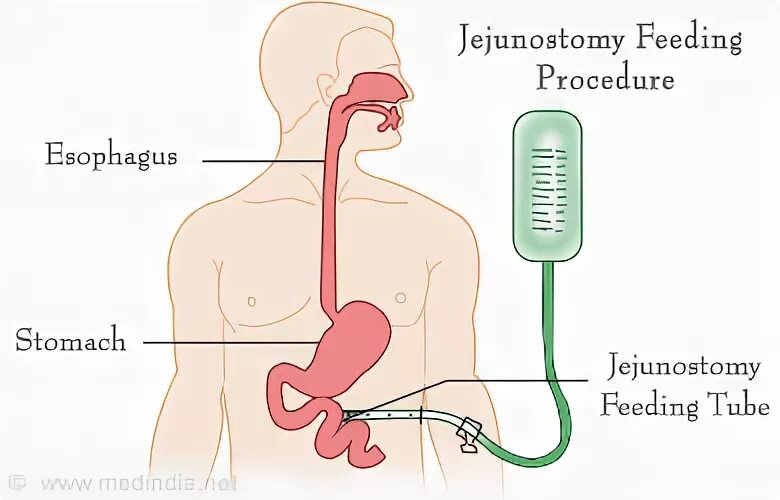 Into procedure. Into procedure