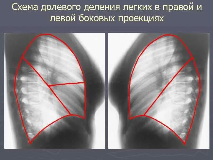 Доли легкого на рентгенограмме. Легкие в боковой проекции. Правое легкое в боковой проекции. Правая боковая проекция легких на рентгене. Боковая проекция легких на рентгене.