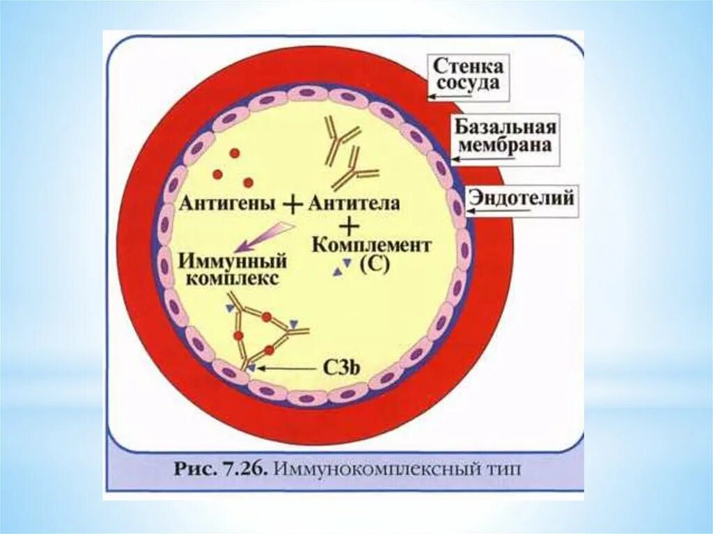 Иммунные часы. Аллергическая реакция 3 типа механизм. Образование иммунных комплексов 3 Тип аллергических реакций. Иммунокомплексный Тип аллергической реакции схема. Механизм аллергической реакции иммунокомплексного типа.