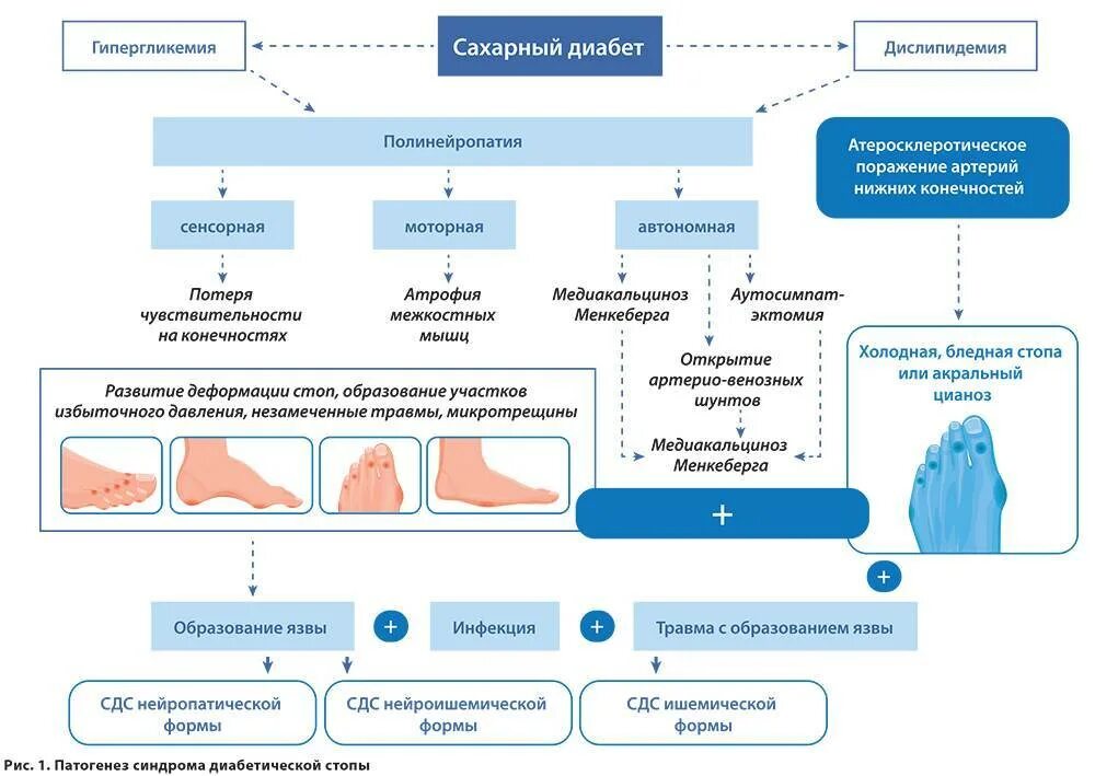 Патогенез диабетической нейропатии схема. Схема механизма развития диабетической нейропатии. Синдром диабетической стопы этиология. Патогенез развития диабетической стопы. Тест диагностика осложнений сахарного диабета