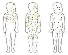 Ветряная оспа высыпания сыпь. Ветрянкой оспа высыпания. Сыпь при ветряная оспа. Ветрянка этапность сыпи.