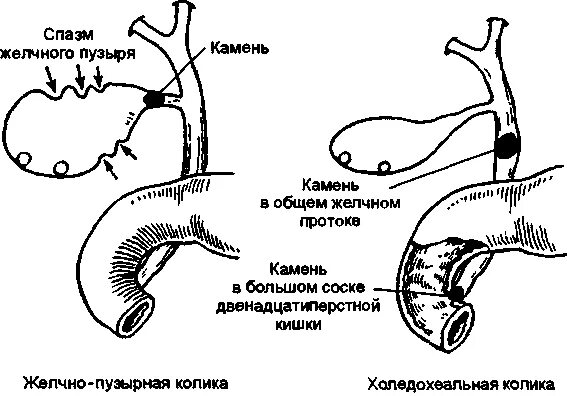 Желчные протоки спазмированы. Спастические сокращения желчного пузыря. Холедохеальная колика. Уменьшенный желчный пузырь