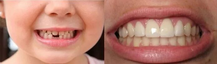 Схема прорезывания коренных зубов в 7 лет. Зубы человека резцы клыки коренные. Какие зубы меняются у детей на коренные схема и в каком порядке. Моляры премоляры схема. Сколько резцов клыков малых и больших коренных у молочных зубов.