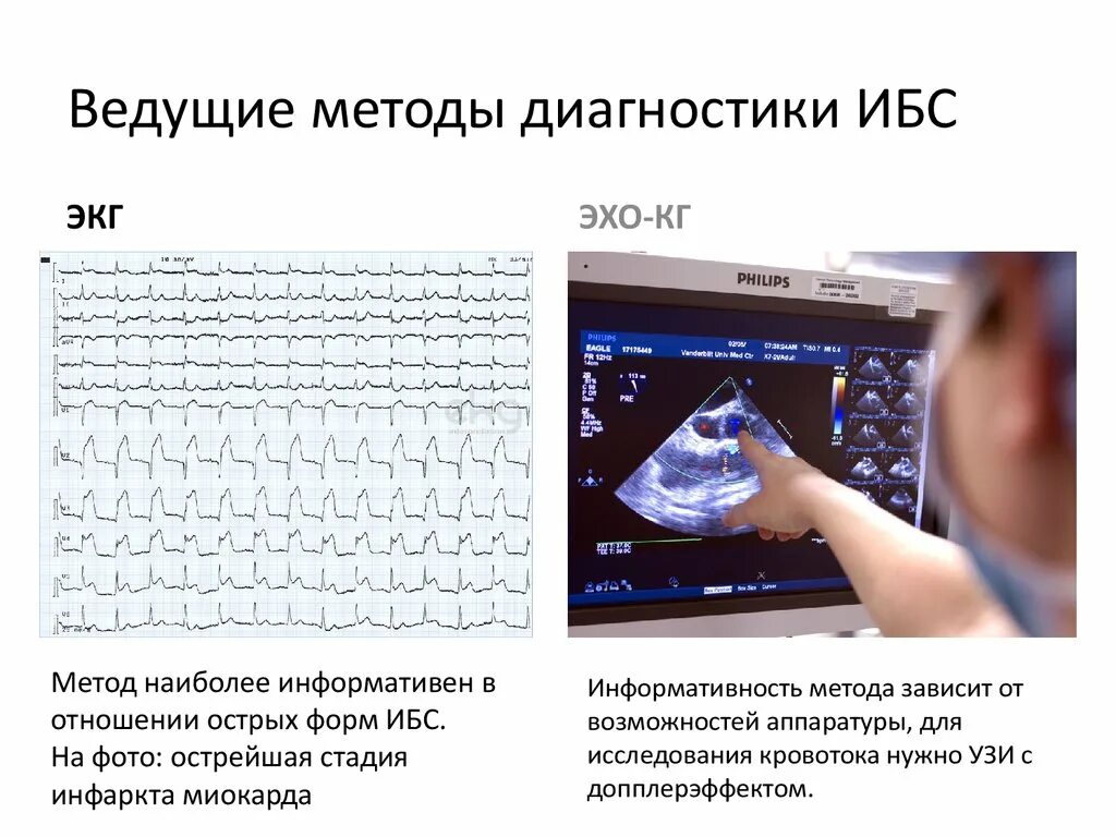 Диагностика ишемии. Методы исследования ИБС. Способы диагностики ИБС. Методы диагностики при ИБС. Основной метод диагностики ИБС:.