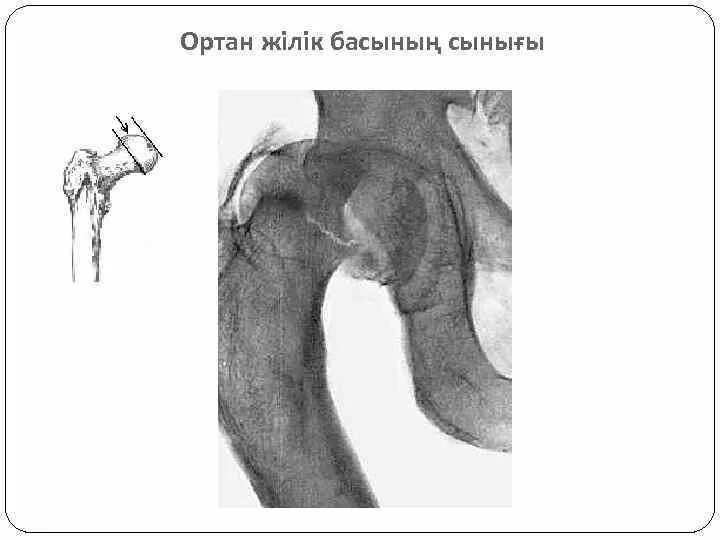 Асептический некроз головки бедренной кости 2 степени. Чрезвертельный перелом шейки бедра. Повреждение головки бедренной кости. Аддукционный перелом шейки бедра рентген. Вколоченный перелом шейки бедра.