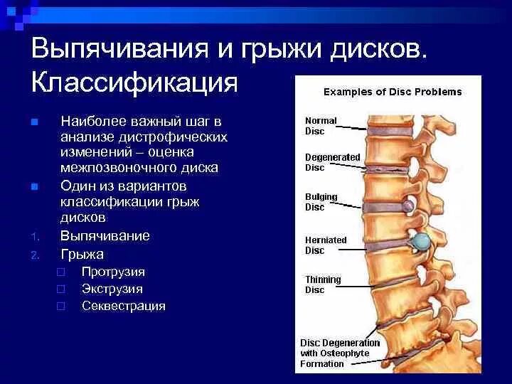 Что такое протрузия позвоночника и экструзия дисков. Что такое протрузия позвоночника и экструзия дисков