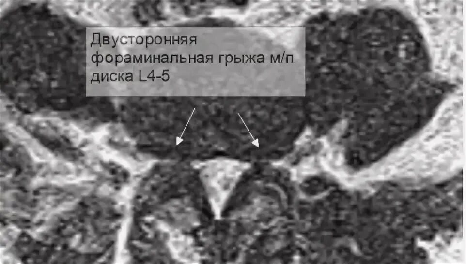 Фораминальная грыжа диска. Фораминальная грыжа межпозвонкового диска. Фораминальная протрузия мрт. Левосторонняя фораминальная грыжа l4 l5. Парамедианная грыжа межпозвонкового диска.