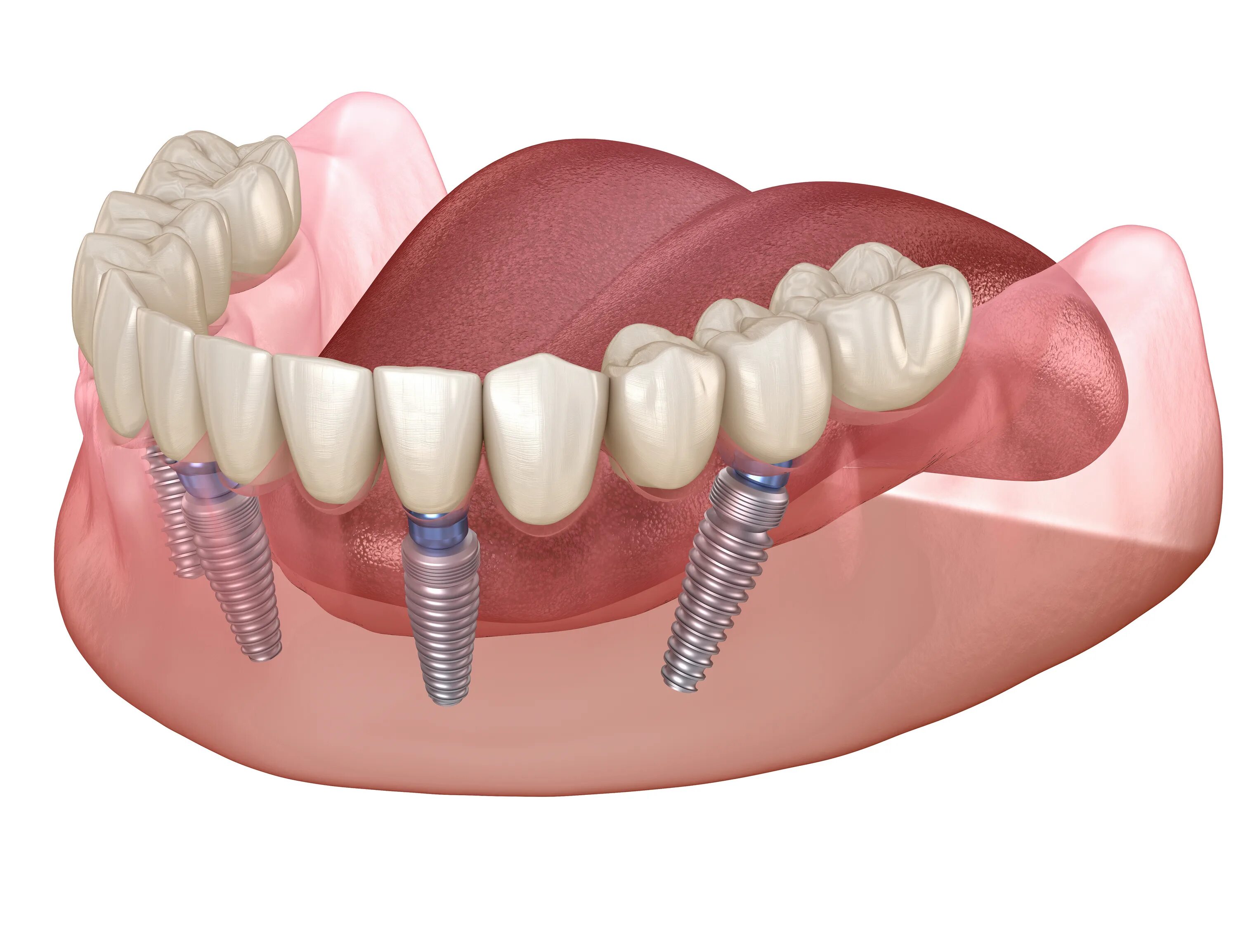 Имплантация зубов по технологии «all on 4» верхней. Ab Dental имплантаты. Имплантация Neodent. Можно ставить импланты при диабете