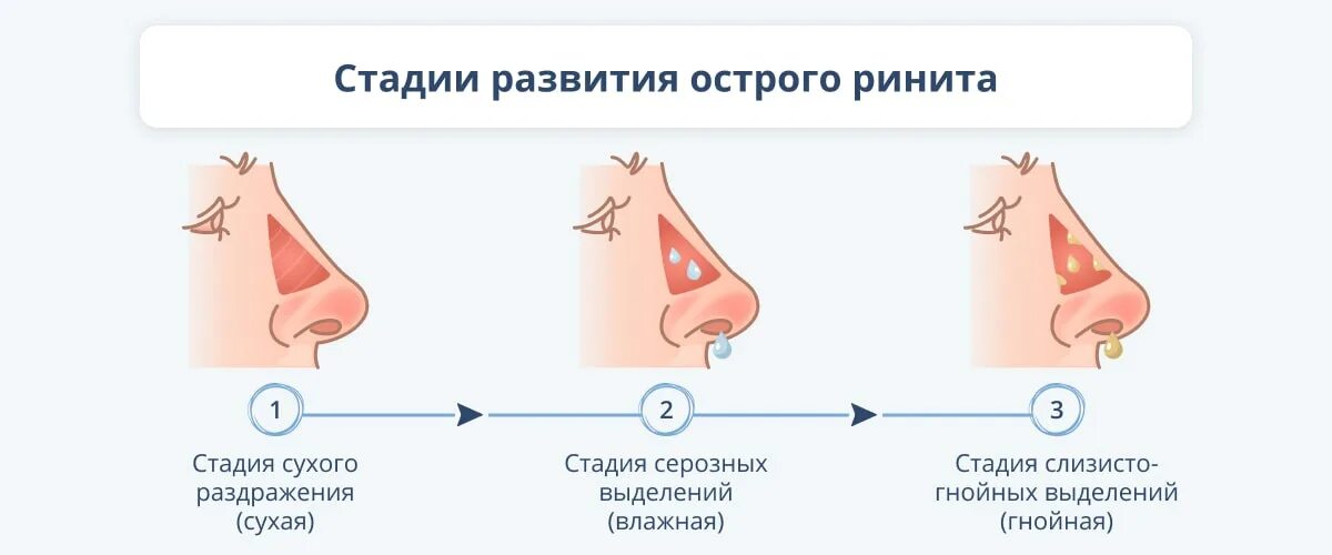 Гнойный насморк у взрослых. Ринит стадии. Острый ринит стадии. Стадии развития насморка. Стадии развития острого ринита.