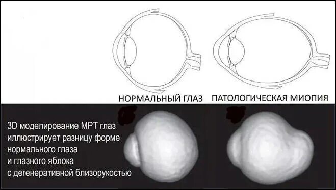 Патологическая миопия. Форма глазного яблока. дегенеративная (патологическая) миопия. форма глазного яблока при миопии.