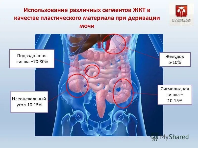 Подвздошная область болит у мужчин. Опухоль подвздошной кишки. Левая подвздошная область кишечника. Дискомфорт в подвздошной кишке. Опухоли в подвздошной области.