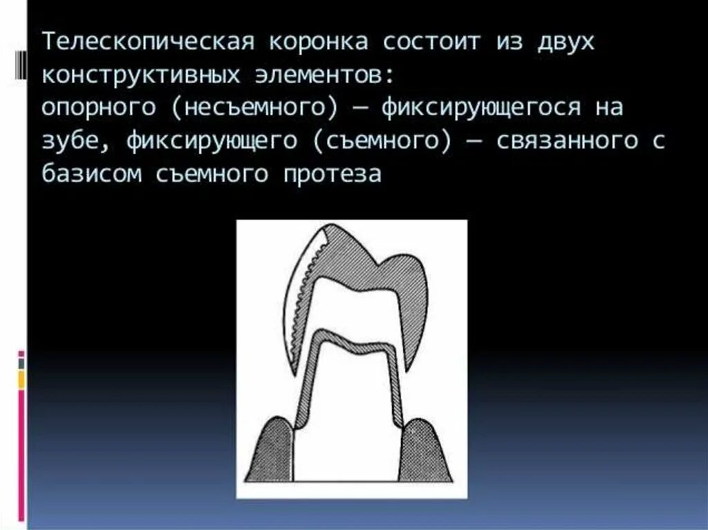 Какую функцию выполняет коронка. Телескопическая коронка с фрикционным штифтом. конические телескопические коронки с фрикционным штифтом. фрикционные элементы для телескопических протезов. телескопические коронки состоят.